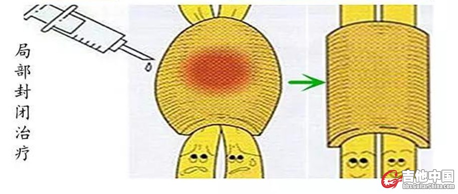 图5  局部封闭疗法